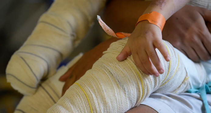 Queimadura causa 14 mil internações no SUS de crianças e adolescentes
