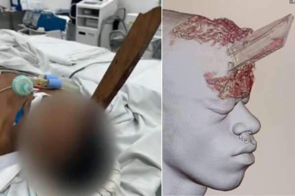 Pedreiro é socorrido em estado grave após ter crânio perfurado por madeira de 40 cm