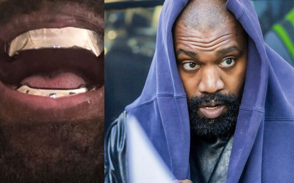 Kanye West troca todos os dentes por próteses de R$ 4 milhões