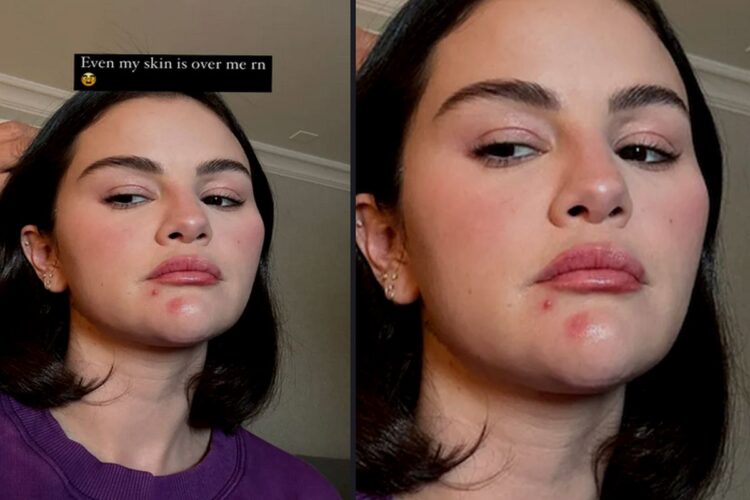 Selena Gomez mostra que ninguém está imune à acne!
