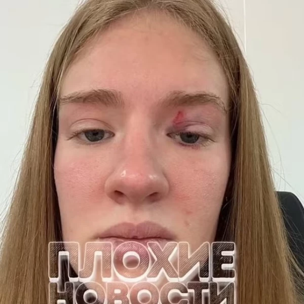 ‘Sereia’ ferida por peixe gigante: imagem do rosto após ataque é divulgada