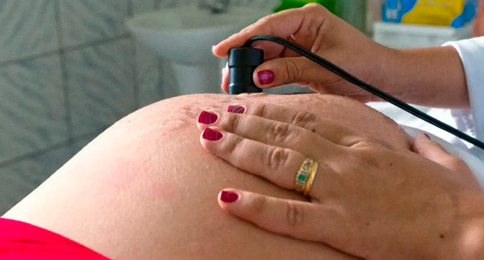 Saúde recomenda cálcio para todas as gestantes para prevenir eclâmpsia