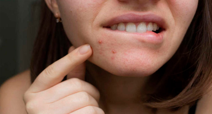 Alimentos que provocam acne; saiba quais são e o que fazer para evitar