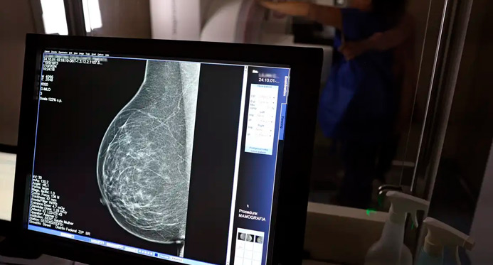 Câncer de mama: uma em cada três pacientes tem menos de 50 anos