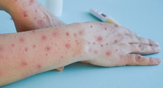 Linhares confirma primeiro caso de Mpox