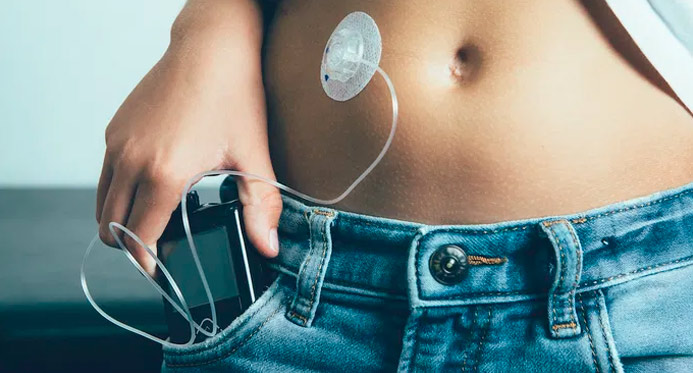 Saiba como sensores e bombas de insulina ajudam no controle do diabetes infantil