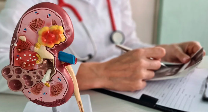 Câncer renal deve crescer quase 80% no Brasil e na América Latina até 2050