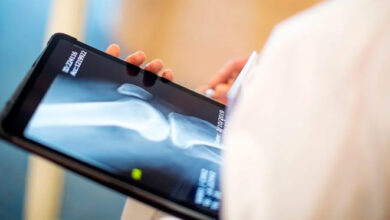 Casos de osteoporose devem disparar até 2050, inclusive no Brasil
