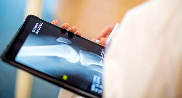 Casos de osteoporose devem disparar até 2050, inclusive no Brasil