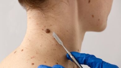 Linhares recebe mutirão com consultas gratuitas contra câncer de pele neste sábado