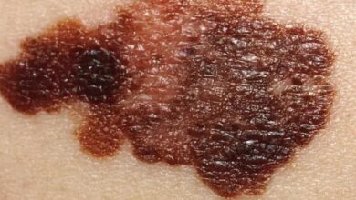 5 sinais e sintomas de câncer de pele (melanoma e não-melanoma)