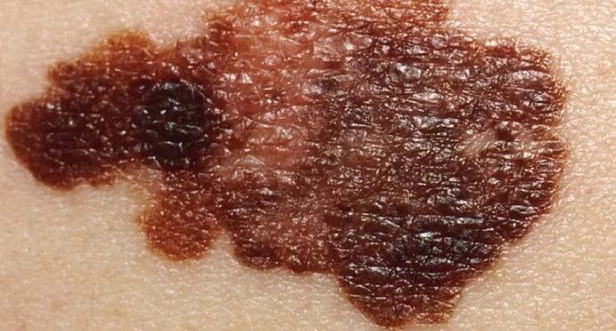 5 sinais e sintomas de câncer de pele (melanoma e não-melanoma)