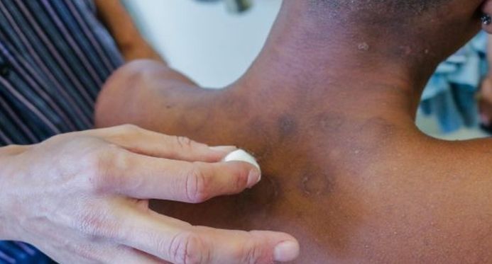 Janeiro Roxo: Brasil é o 2º país com mais casos de hanseníase no mundo; saiba identificar os sinais na pele