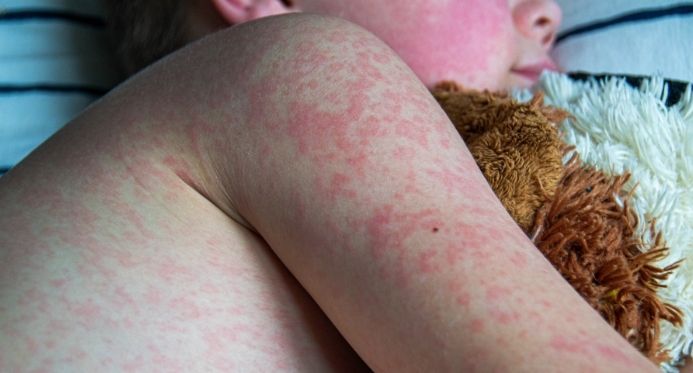 Casos de sarampo disparam 32 vezes nas Américas e Brasil reforça alerta para viajantes