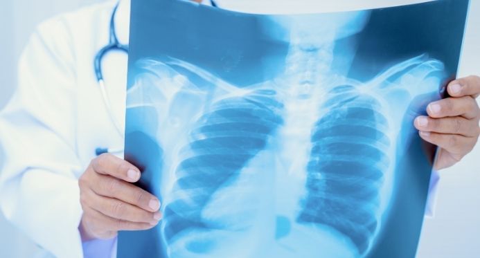 ES registra 1.916 casos de tuberculose em 2025 e reforça importância de tratamento gratuito pelo SUS