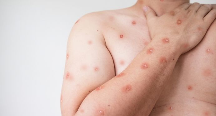 Espírito Santo confirma segundo caso de Mpox em 2026 e já soma 44 notificações