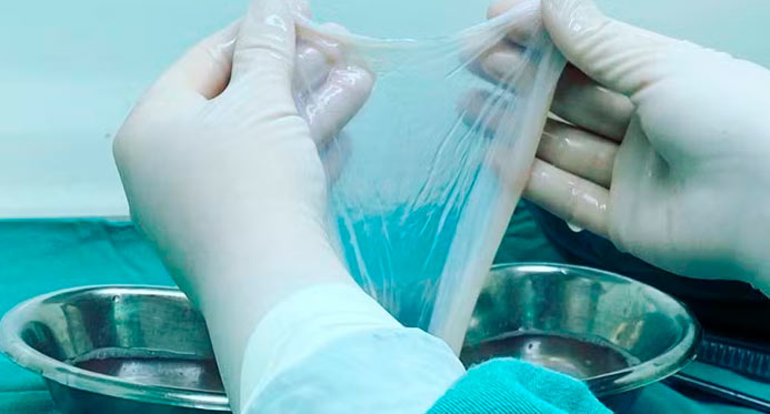 Saúde incorpora transplante da membrana amniótica para tratar diabetes